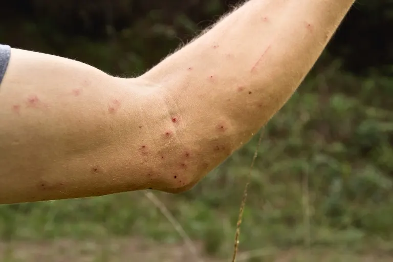how many mosquito bites will kill you
