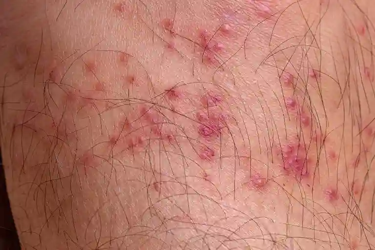 how to banish mosquito bite marks fast