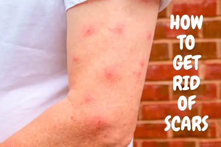 how to get rid of mosquitoes scars