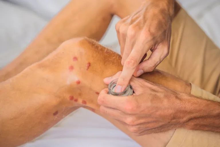 how to lighten mosquito bite scars
