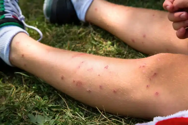 how to prevent mosquito bites from scarring