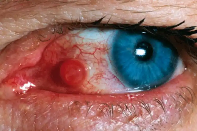 what happens if a mosquito bites your eyeball