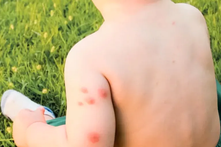 What to Put on Infant Mosquito Bites: Effective Remedies
