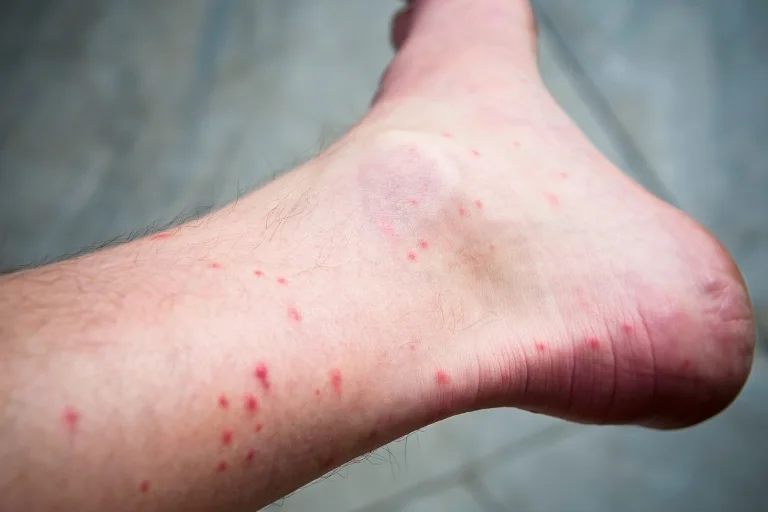 why do mosquitoes target ankles