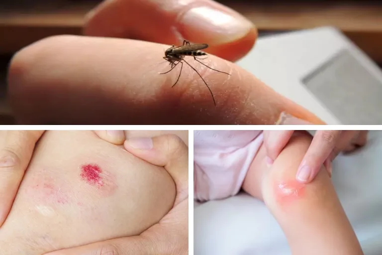 why do my mosquito bites bruise
