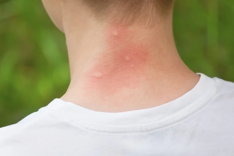 why does mosquito bites leave scars