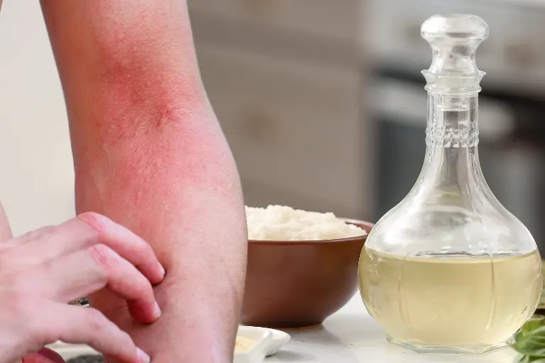 why does vinegar help mosquito bites